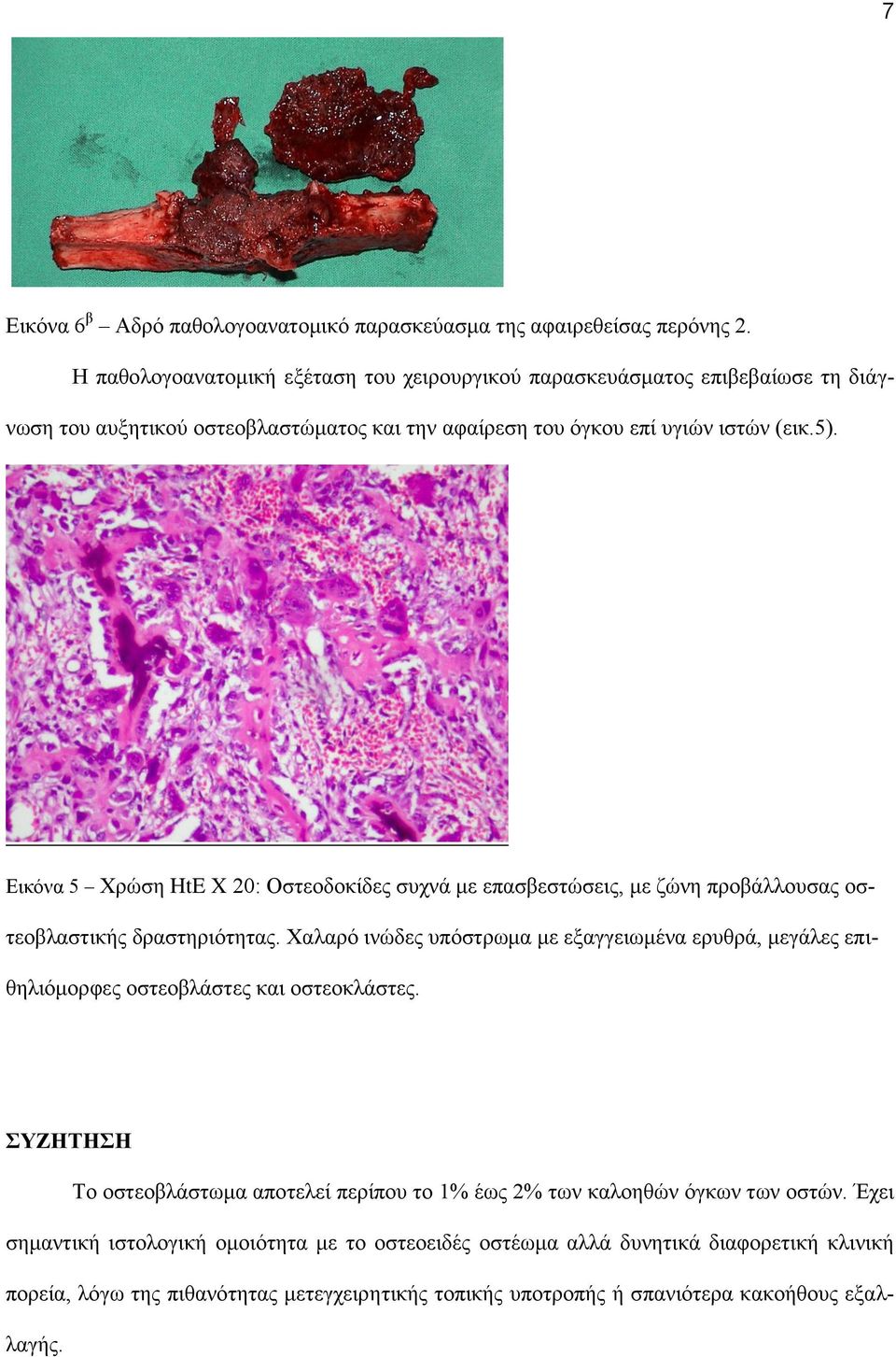 Εικόνα 5 Χρώση HtE X 20: Οστεοδοκίδες συχνά με επασβεστώσεις, με ζώνη προβάλλουσας οστεοβλαστικής δραστηριότητας.