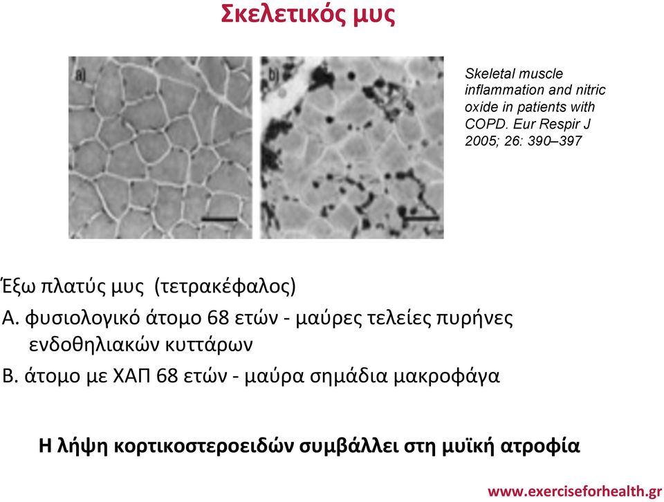 φυσιολογικό άτομο 68 ετών - μαύρες τελείες πυρήνες ενδοθηλιακών κυττάρων Β.