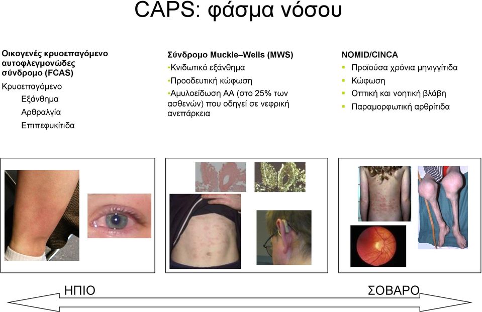 χρόνια µηνιγγίτιδα Προοδευτική κώφωση Αµυλοείδωση AA (στο 25% των ασθενών) που οδηγεί σε