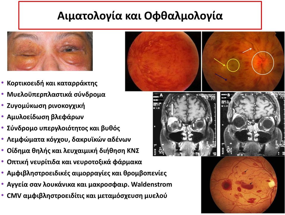 Οίδημα θηλής και λευχαιμική διήθηση ΚΝΣ Οπτική νευρίτιδα και νευροτοξικά φάρμακα Αμφιβληστροειδικές