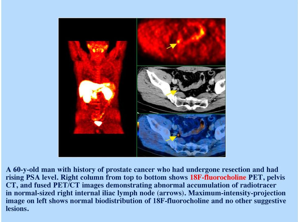 demonstrating abnormal accumulation of radiotracer in normal-sized right internal iliac lymph node (arrows).