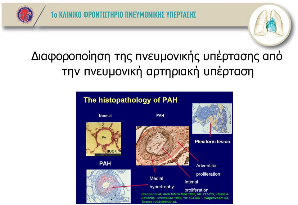 υπέρτασης από την