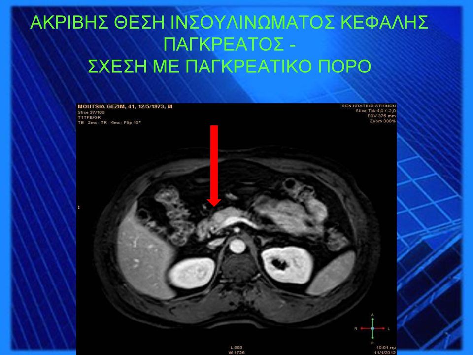 ΚΕΦΑΛΗΣ ΠΑΓΚΡΕΑΤΟΣ