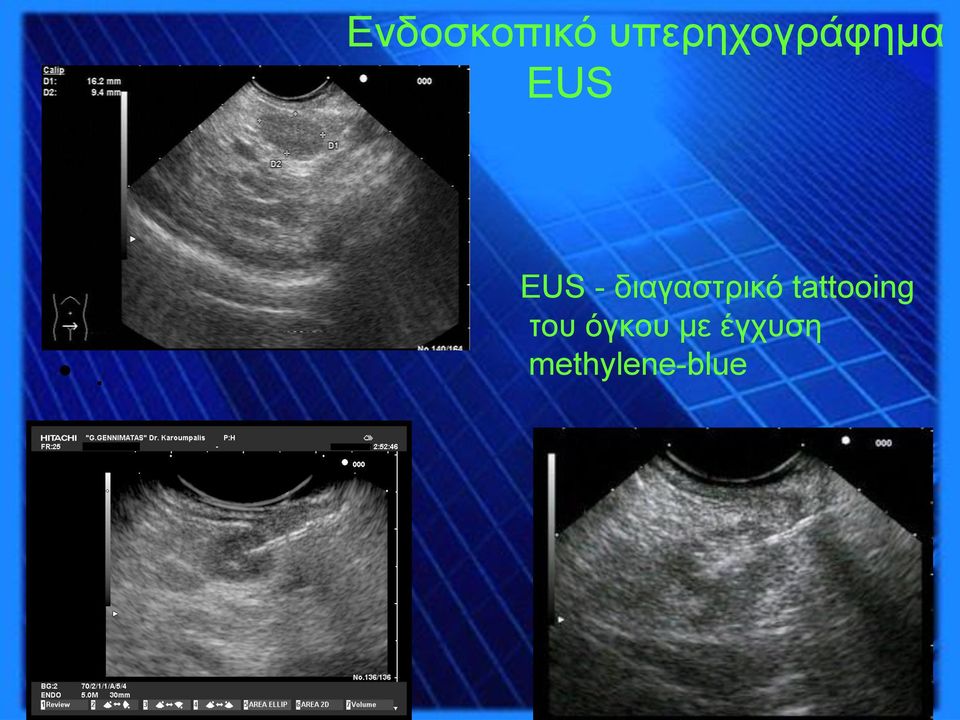 EUS - διαγαστρικό