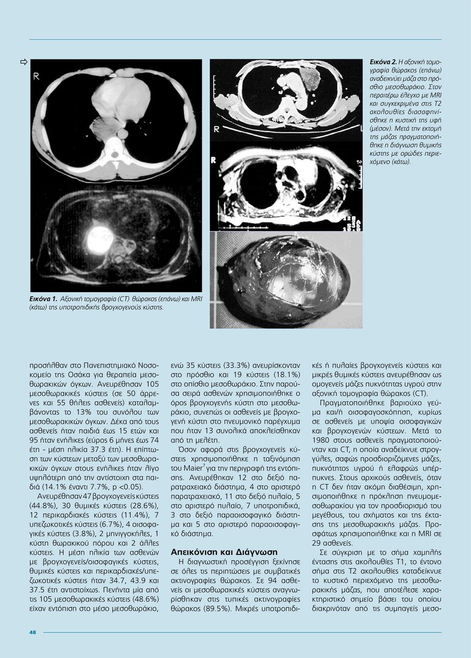 Αξονική τομογραφία (CT) θώρακος (επάνω) και MRI (κάτω) της υποτροπιδικής βρογχογενούς κύστης. προσήλθαν στο Πανεπιστημιακό Νοσοκομείο της Οσάκα για θεραπεία μεσοθωρακικών όγκων.