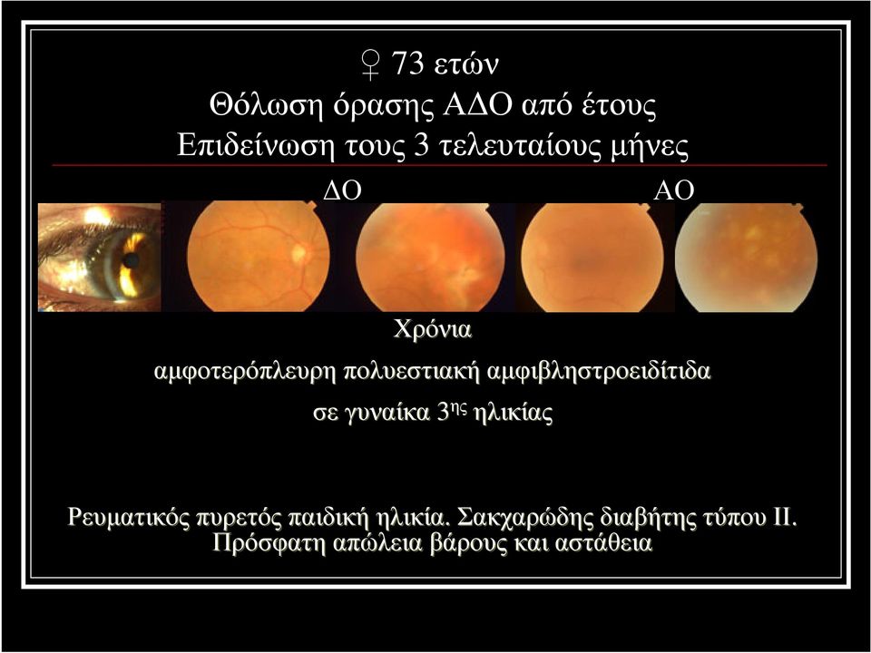 αµφιβληστροειδίτιδα σε γυναίκα 3 ης ηλικίας Ρευµατικός πυρετός