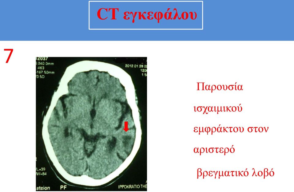 ισχαιμικού