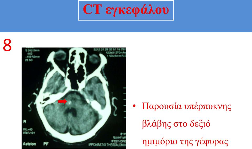 υπέρπυκνης βλάβης