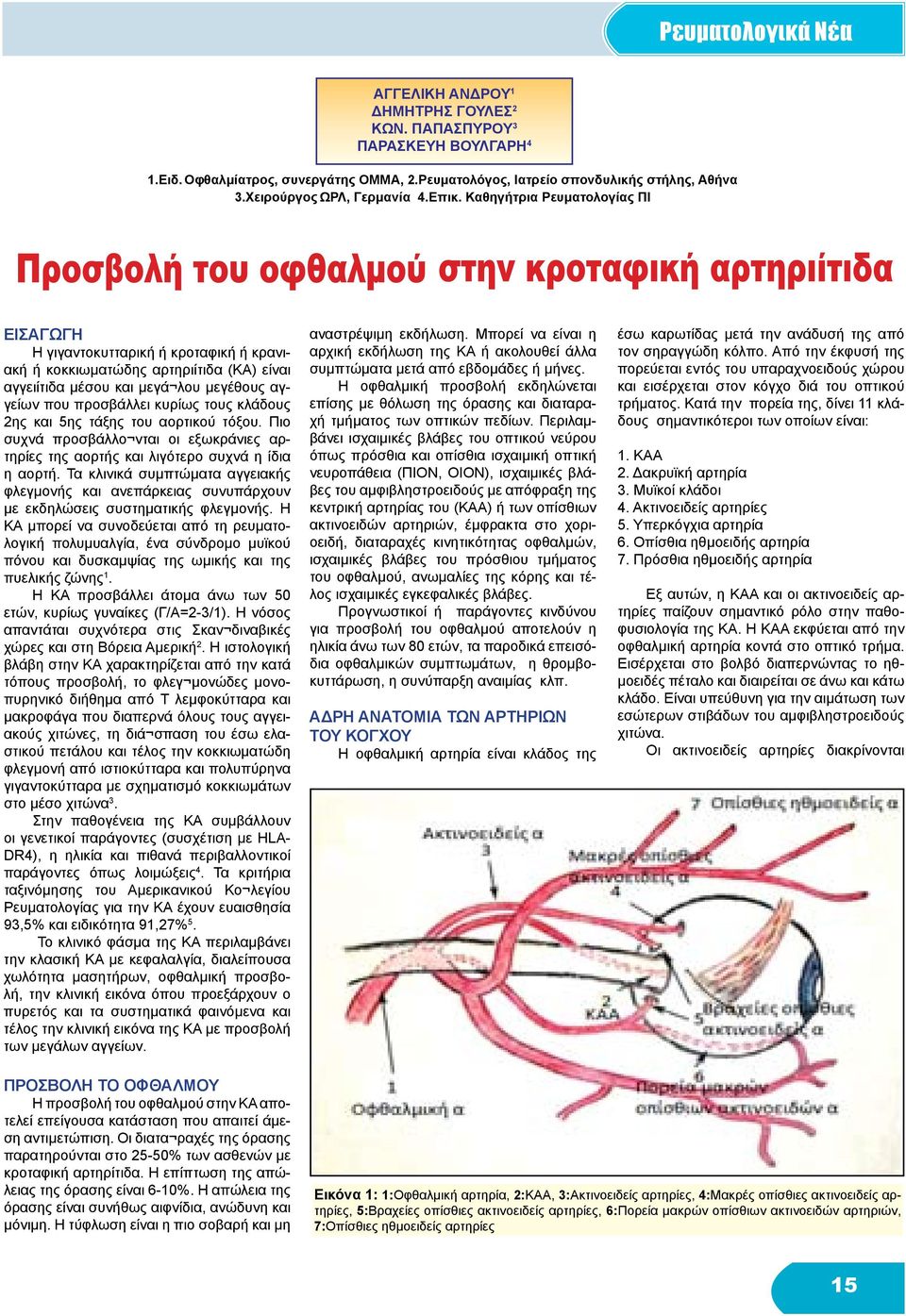 Καθηγήτρια Ρευματολογίας ΠΙ ΕΙΣΑΓΩΓΗ Η γιγαντοκυτταρική ή κροταφική ή κρανιακή ή κοκκιωματώδης αρτηριίτιδα (ΚΑ) είναι αγγειίτιδα μέσου και μεγά λου μεγέθους αγγείων που προσβάλλει κυρίως τους κλάδους