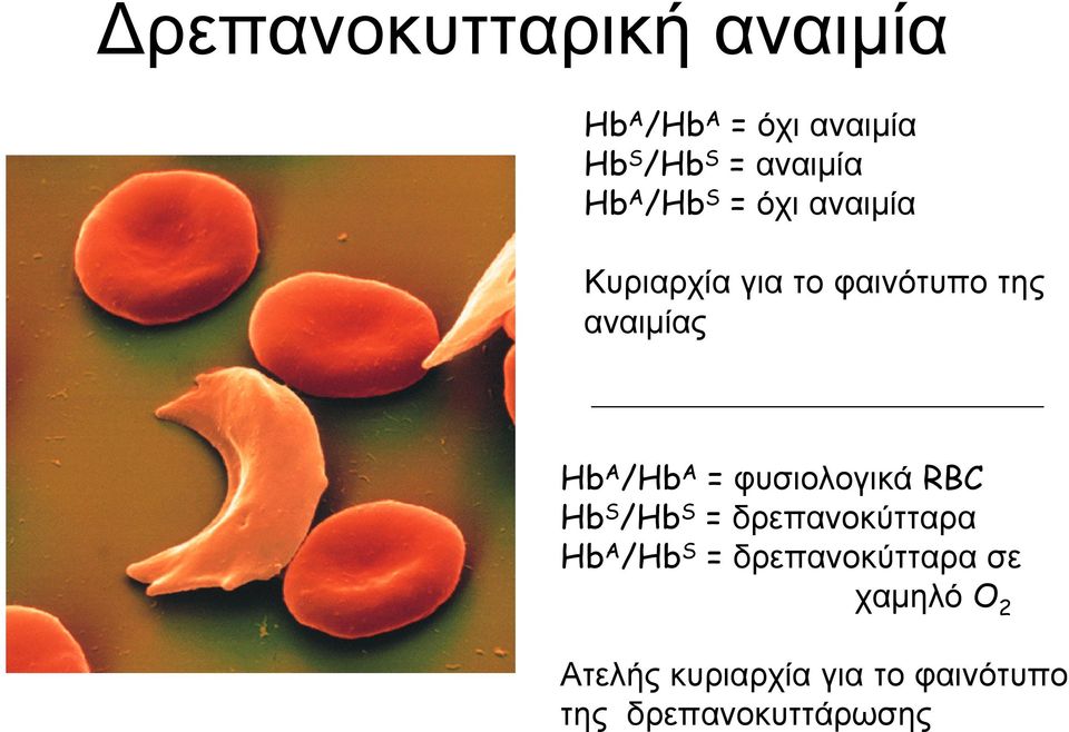 = φυσιολογικά RBC Hb S /Hb S = δρεπανοκύτταρα Hb A /Hb S =