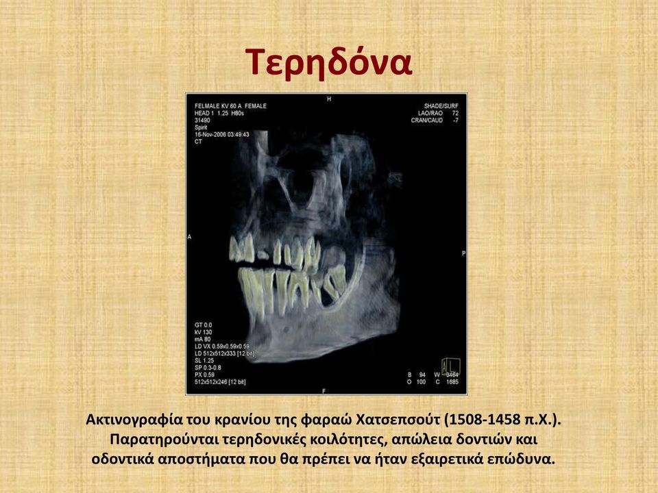 Παρατηρούνται τερηδονικές κοιλότητες, απώλεια