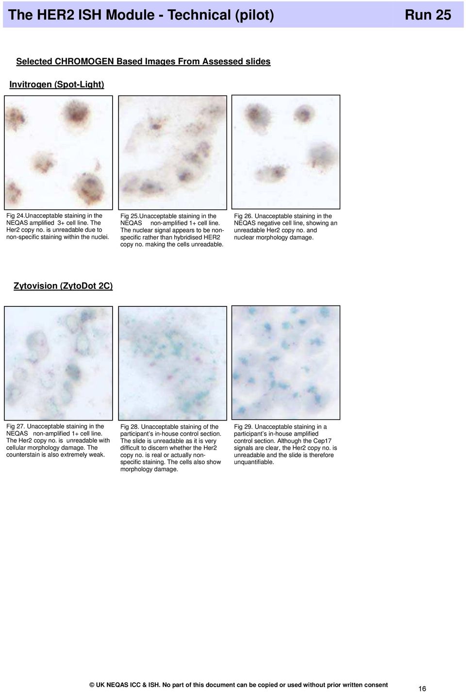 The nuclear signal appears to be nonspecific rather than hybridised HER2 copy no. making the cells unreadable. Fig 26.