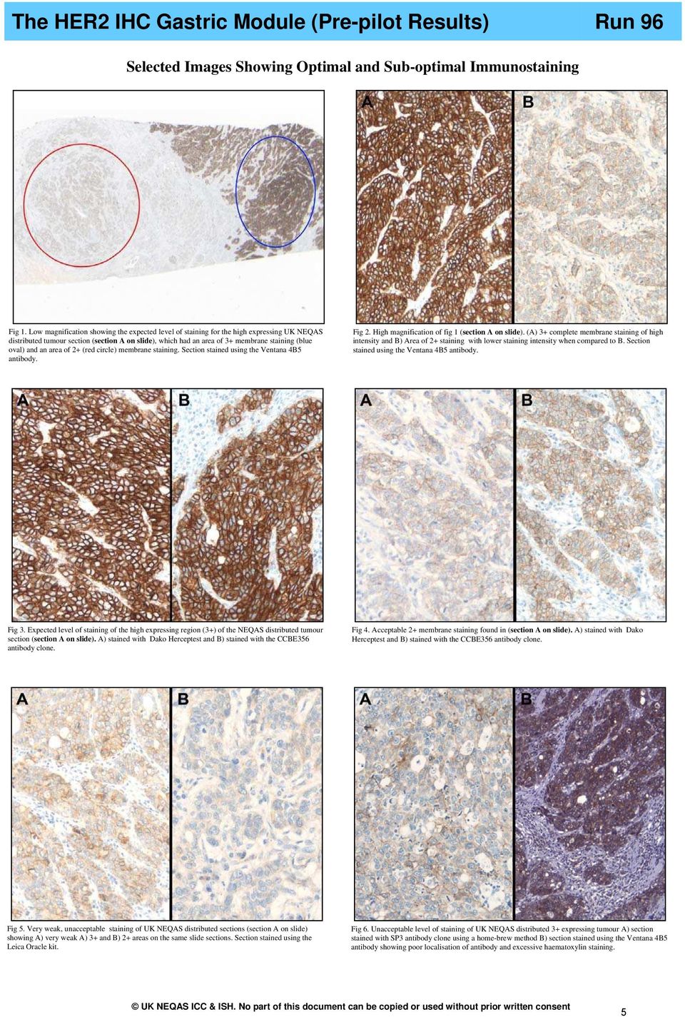 area of 2+ (red circle) membrane staining. Section stained using the Ventana 4B5 antibody. Fig 2. High magnification of fig 1 (section A on slide).