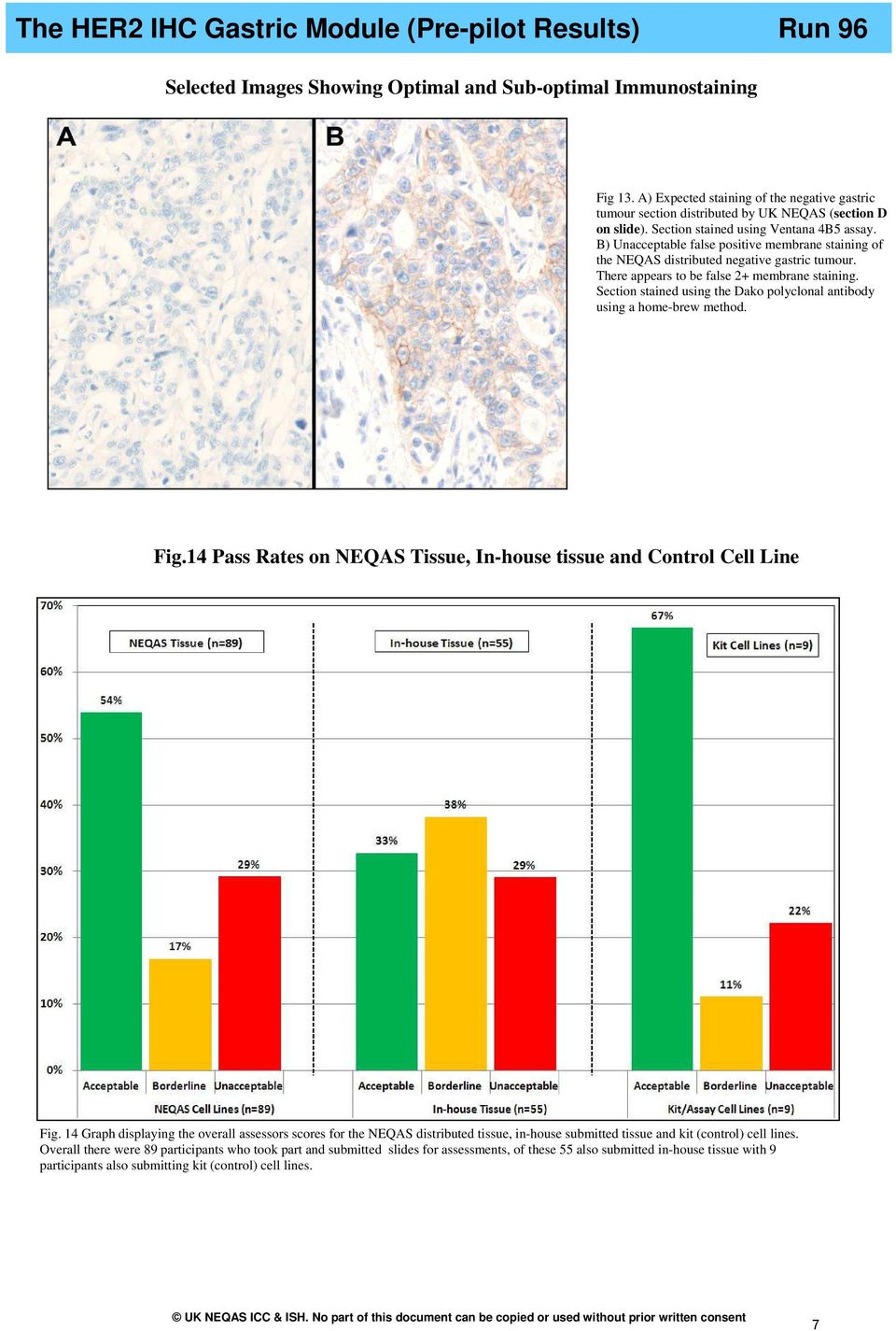 B) Unacceptable false positive membrane staining of the NEQAS distributed negative gastric tumour. There appears to be false 2+ membrane staining.