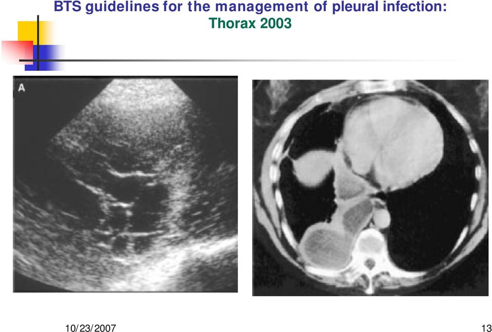 pleural infection: