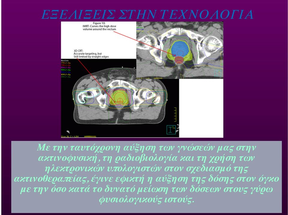 στον σχεδιασμό της ακτινοθεραπείας, έγινε εφικτή η αύξηση της δόσης στον