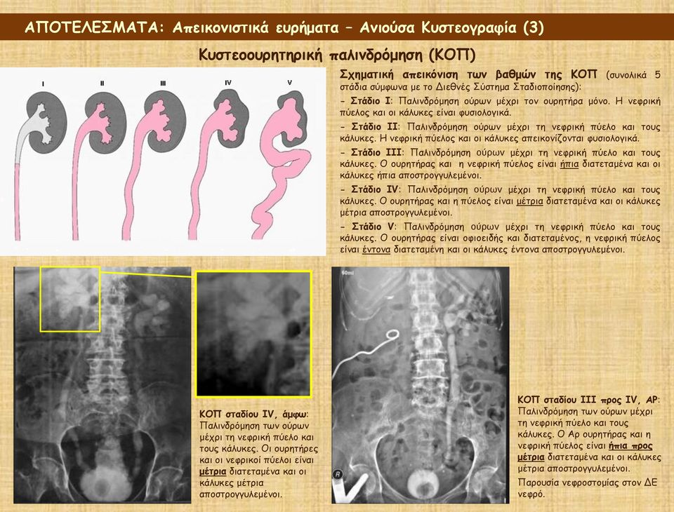 Η νεφρική πύελος και οι κάλυκες απεικονίζονται φυσιολογικά. - Στάδιο ΙΙΙ: Παλινδρόμηση ούρων μέχρι τη νεφρική πύελο και τους κάλυκες.