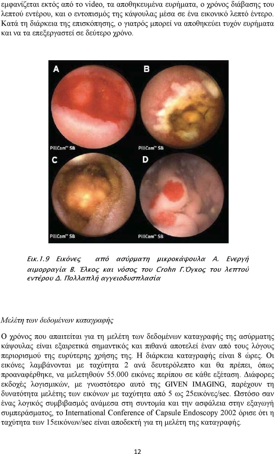 Έλκος και νόσος του Crohn Γ.Όγκος του λεπτού εντέρου Δ.