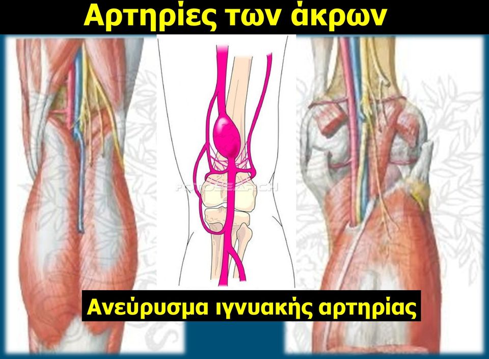 Ανεύρυσμα