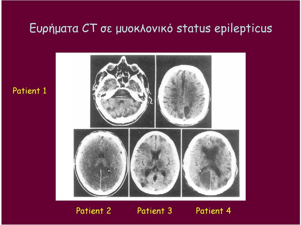 epilepticus Patient