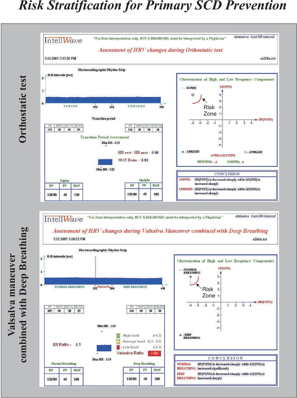 Risk Zone Valsalva maneuver