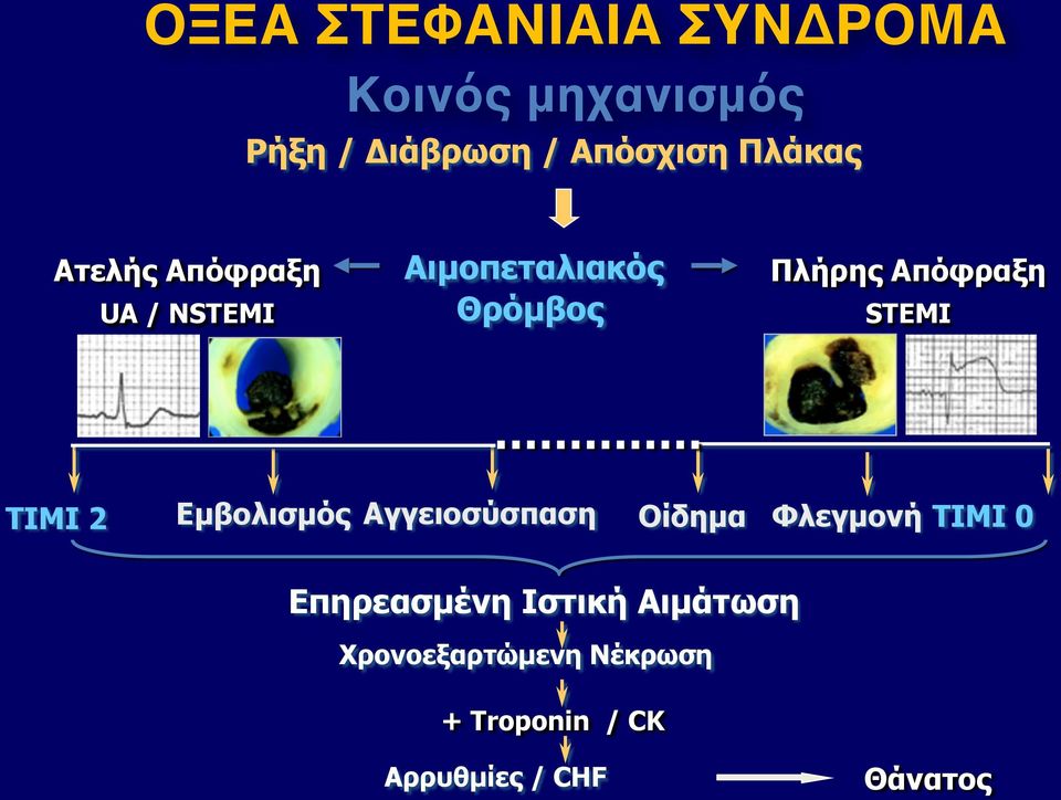 STEMI TIMI 2 Εµβολισµός Αγγειοσύσπαση Οίδηµα Φλεγµονή TIMI 0 Επηρεασµένη