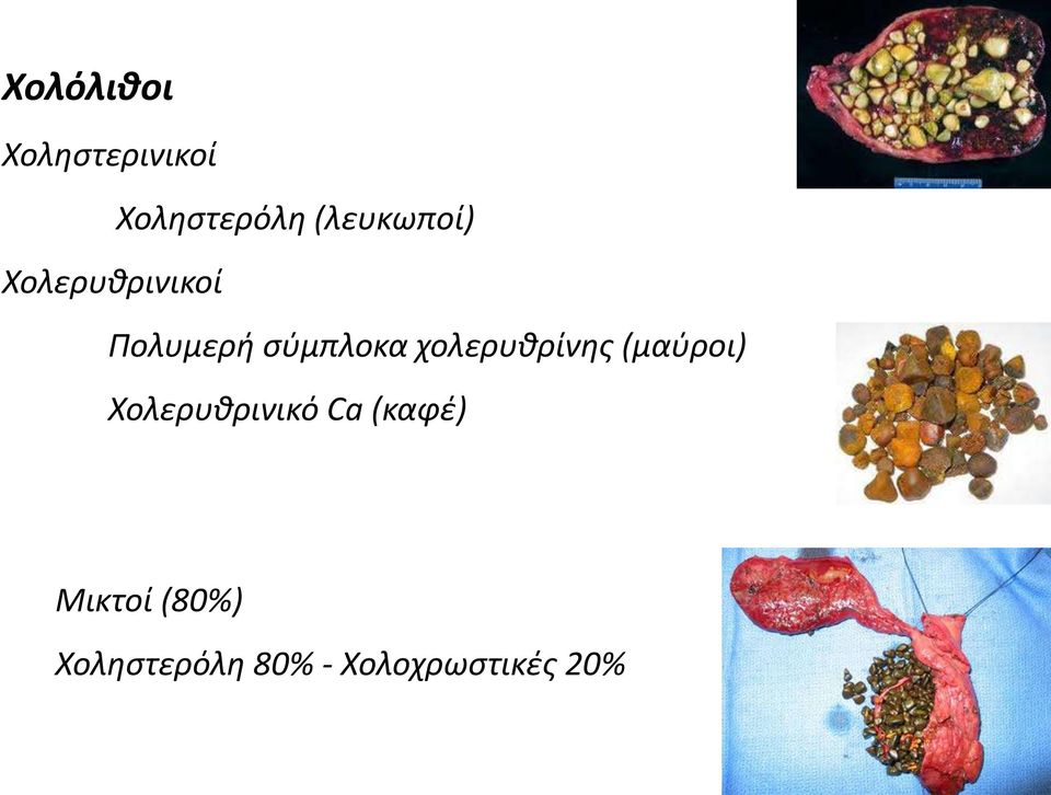 χολερυθρίνης (μαύροι) Χολερυθρινικό Ca