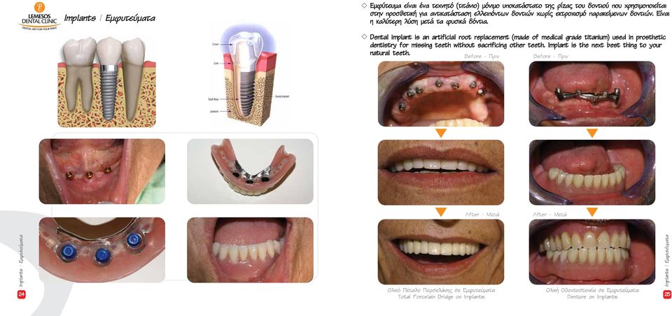 Dental implant is an artificial root replacement (made of medical grade titanium) used in prosthetic dentistry for missing teeth without sacrificing other teeth.