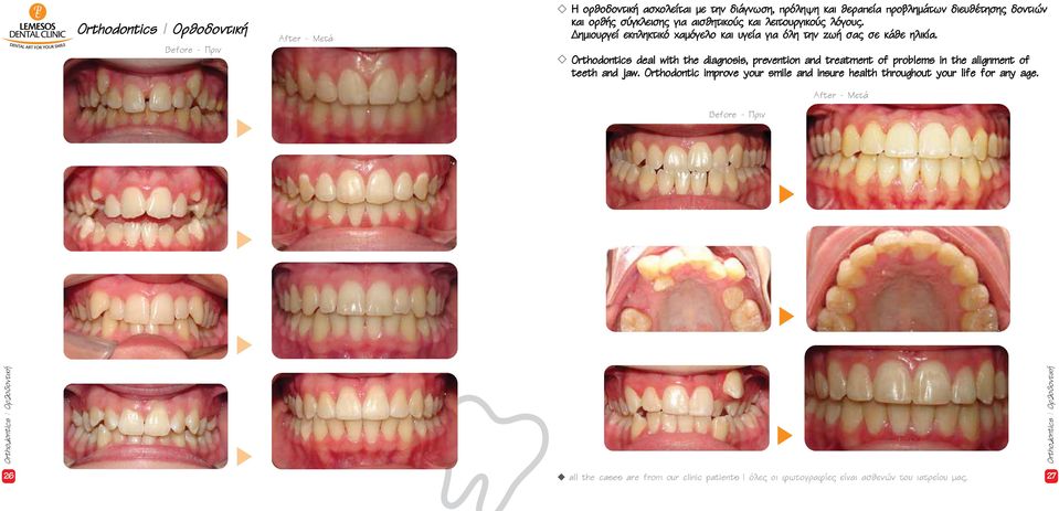 Orthodontics deal with the diagnosis, prevention and treatment of problems in the alignment of teeth and jaw.