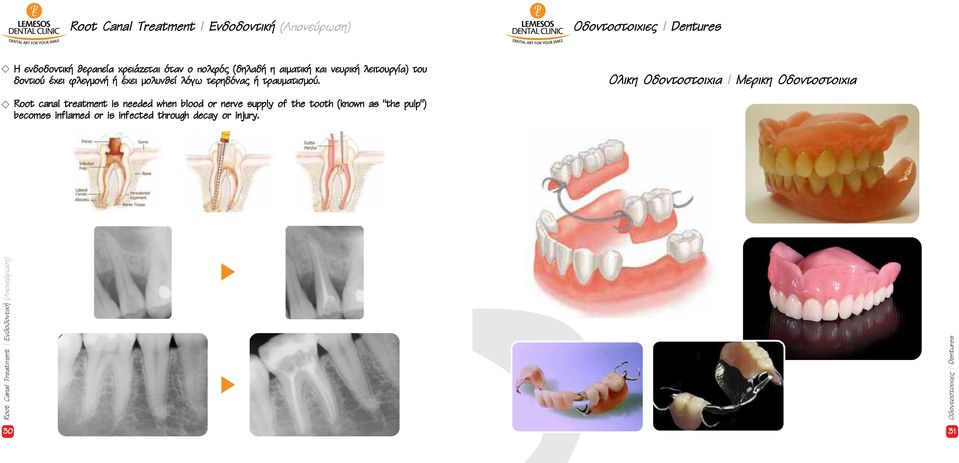 Ολικη Οδοντοστοιχια Μερικη Οδοντοστοιχια Root canal treatment is needed when blood or nerve supply of the tooth (known as