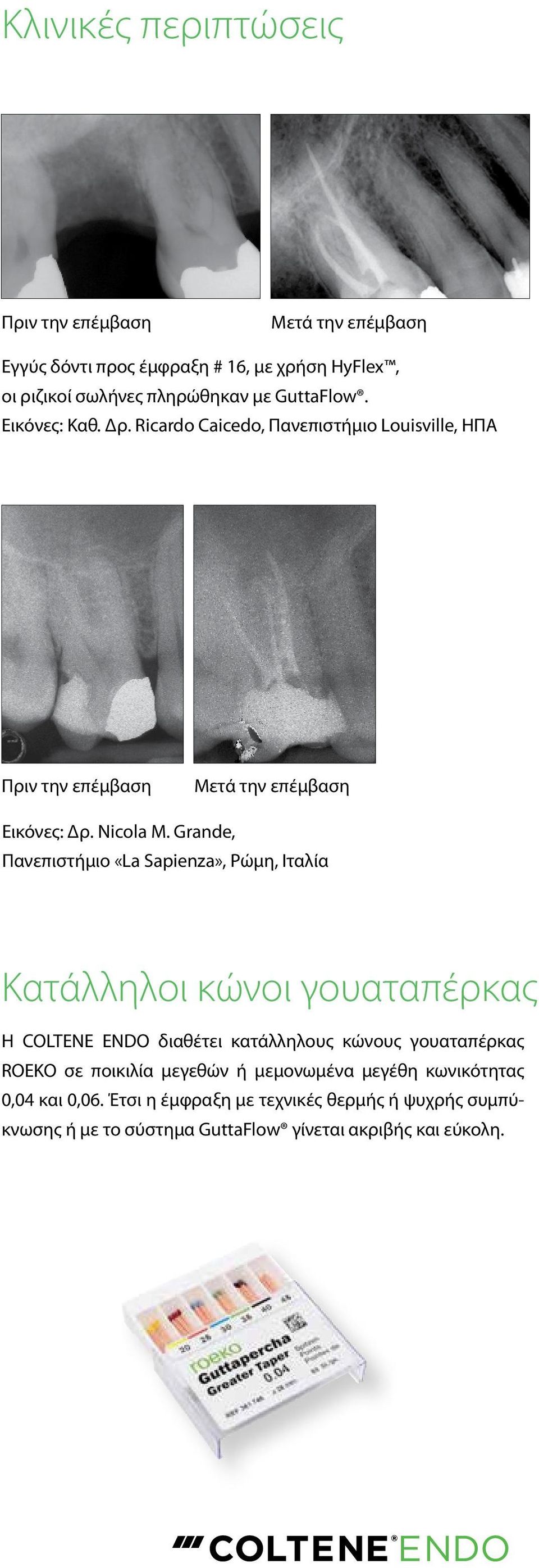Grande, Πανεπιστήμιο «La Sapienza», Ρώμη, Ιταλία Κατάλληλοι κώνοι γουαταπέρκας Η COLTENE ENDO διαθέτει κατάλληλους κώνους γουαταπέρκας ROEKO σε
