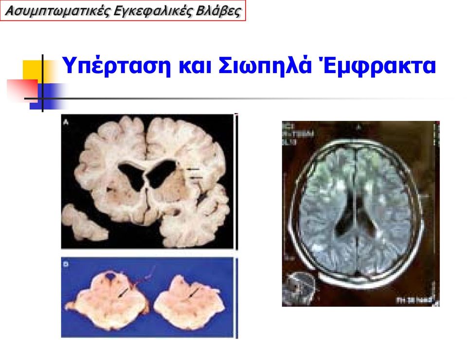 Βλάβες Υπέρταση