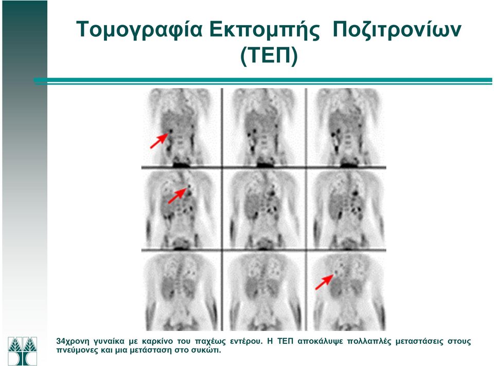 εντέρου.