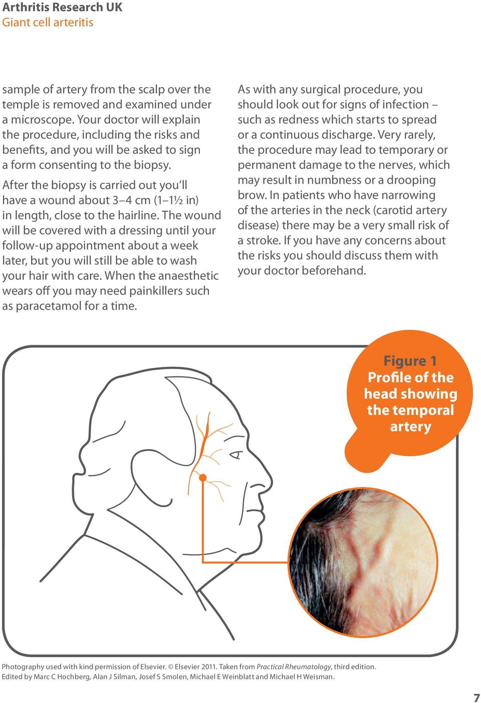 After the biopsy is carried out you ll have a wound about 3 4 cm (1 1½ in) in length, close to the hairline.