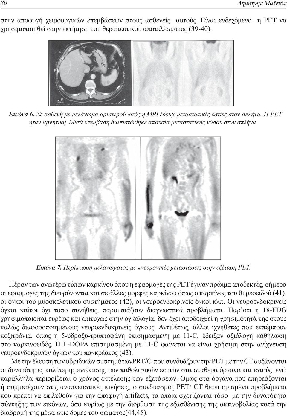 Περίπτωση μελανώματος με πνευμονικές μεταστάσεις στην εξέταση ΡΕΤ.