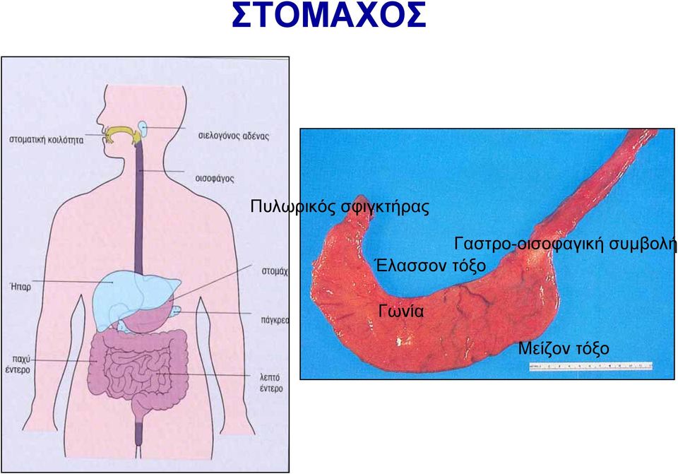 Γαστρο-οισοφαγική