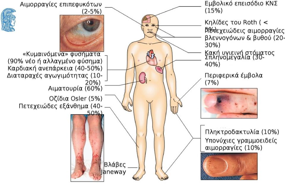 επεισόδιο ΚΝΣ (15%) Κηλίδες του Roth ( < 5%) Πετεχειώδεις αιμορραγίες βλεννογόνων & βυθού (20-30%) Κακή υγιεινή
