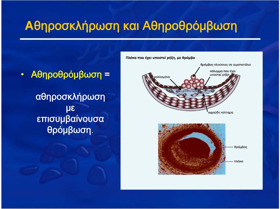 = αθηροσκλήρωση με