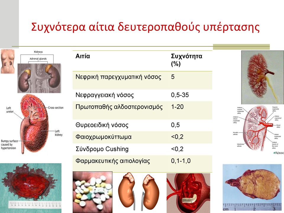 Πρωτοπαθής αλδοστερονισμός 1-20 Θυρεοειδική νόσος 0,5