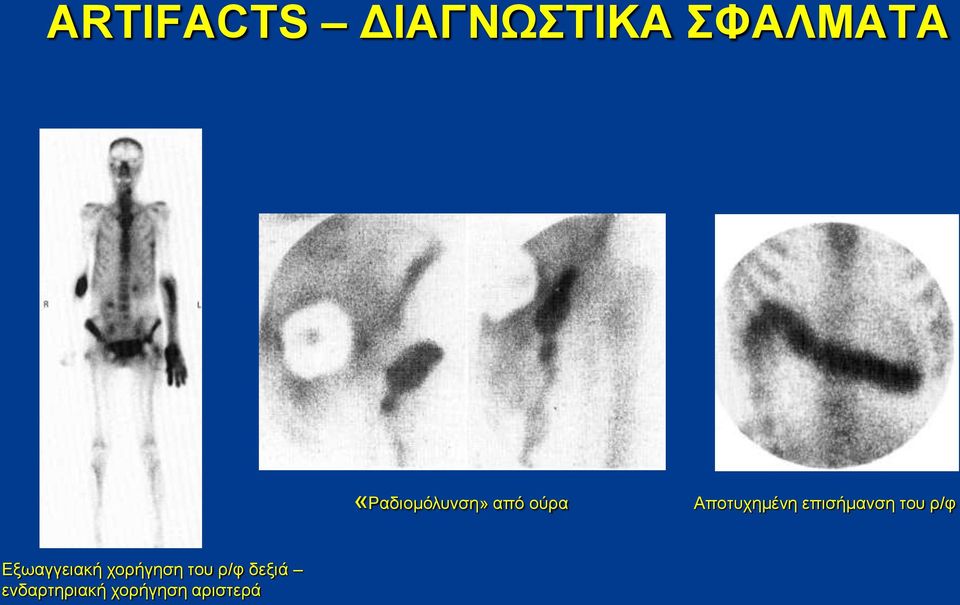 επισήμανση του ρ/φ Εξωαγγειακή