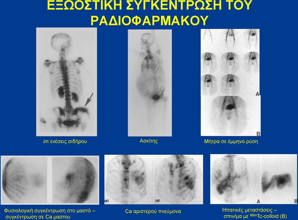 συγκέντρωση στο μαστό συγκέντρωση σε Ca μαστου Ca