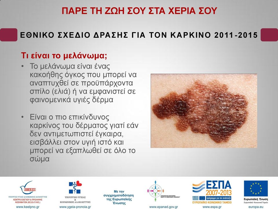 θαηλνκεληθά πγηέο δέξκα Είλαη ν πην επηθίλδπλνο θαξθίλνο ηνπ δέξκαηνο γηαηί εάλ