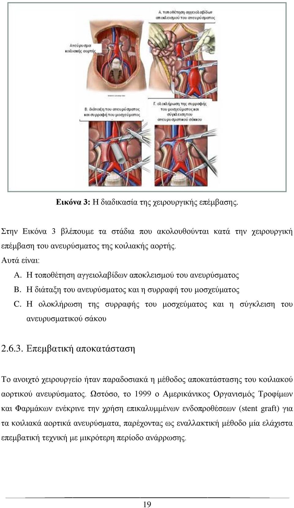 Η ολοκλήρωση της συρραφής του μοσχεύματος και η σύγκλειση του ανευρυσματικού σάκου 2.6.3.