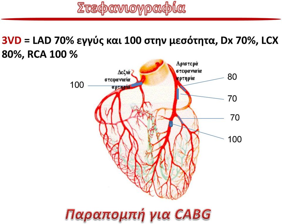 μεσότητα, Dx 70%, LCX