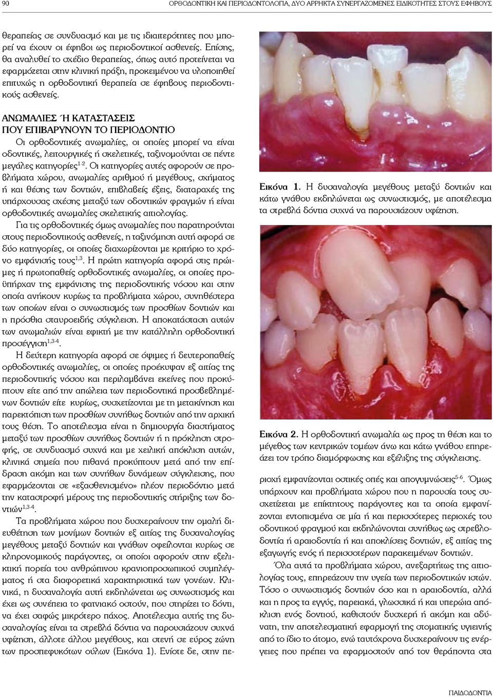 Εικόνα 1. Η δυσαναλογία μεγέθους μεταξύ δοντιών και κάτω γνάθου εκδηλώνεται ως συνωστισμός, με αποτέλεσμα τα στρεβλά δόντια συχνά να παρουσιάζουν υφίζηση. Εικόνα 2.