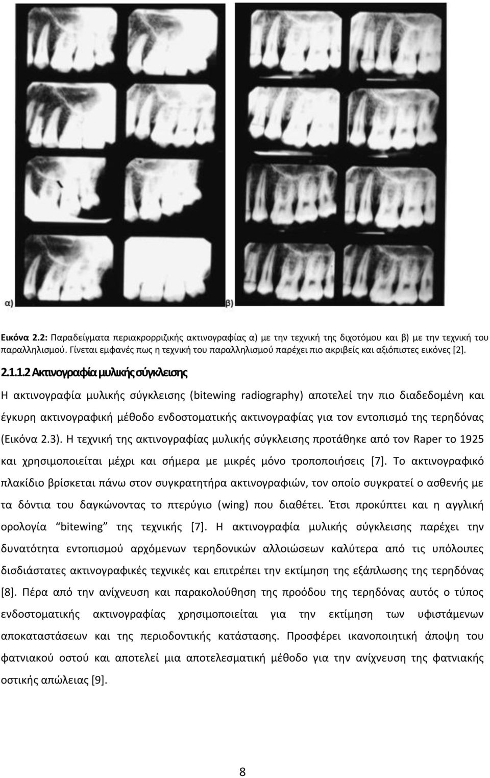 1.2 Ακτινογραφία μυλικής σύγκλεισης Η ακτινογραφία μυλικής σύγκλεισης (bitewing radiography) αποτελεί την πιο διαδεδομένη και έγκυρη ακτινογραφική μέθοδο ενδοστοματικής ακτινογραφίας για τον