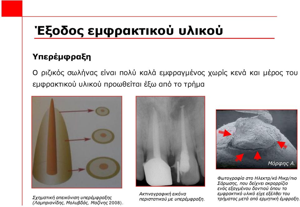 Σχηματική απεικόνιση υπερέμφραξης (Λαμπριανίδης, Μολυβδάς, Μαζίνης 2008).