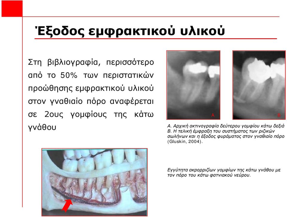 Αρχική ακτινογραφία δεύτερου γομφίου κάτω δεξιά Β.