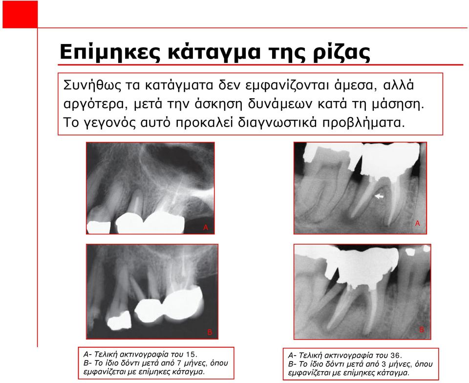 A A Β Β Α- Τελική ακτινογραφία του 15.