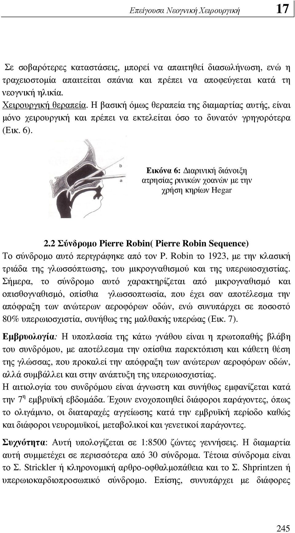 Εικόνα 6: ιαρινική διάνοιξη ατρησίας ρινικών χοανών µε την χρήση κηρίων Hegar 2.2 Σύνδροµο Pierre Robin( Pierre Robin Sequence) Το σύνδροµο αυτό περιγράφηκε από τον P.